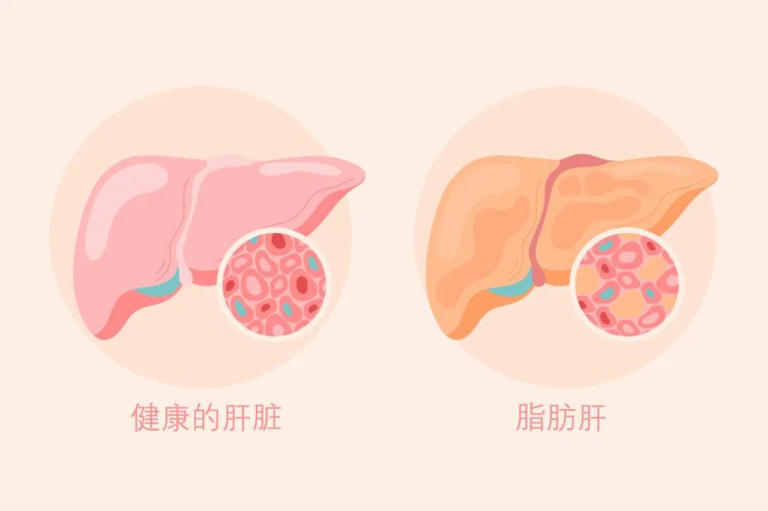 拒绝盲目减肥！中老年人群科学减重记住四个要点→