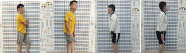 9岁男孩左脚踮走，手术后稳稳迈步，未来还能跑吗？
