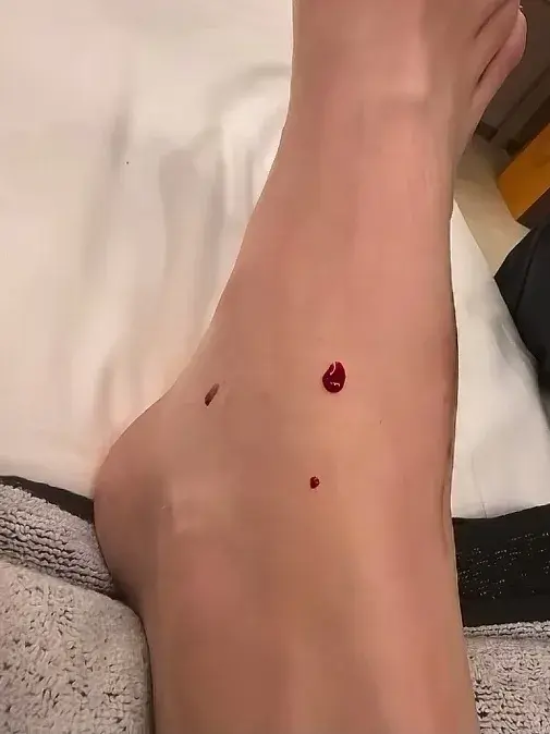 李盈莹公布康复过程！脚上扎出血，泳池中练腕力，身上满是伤痕