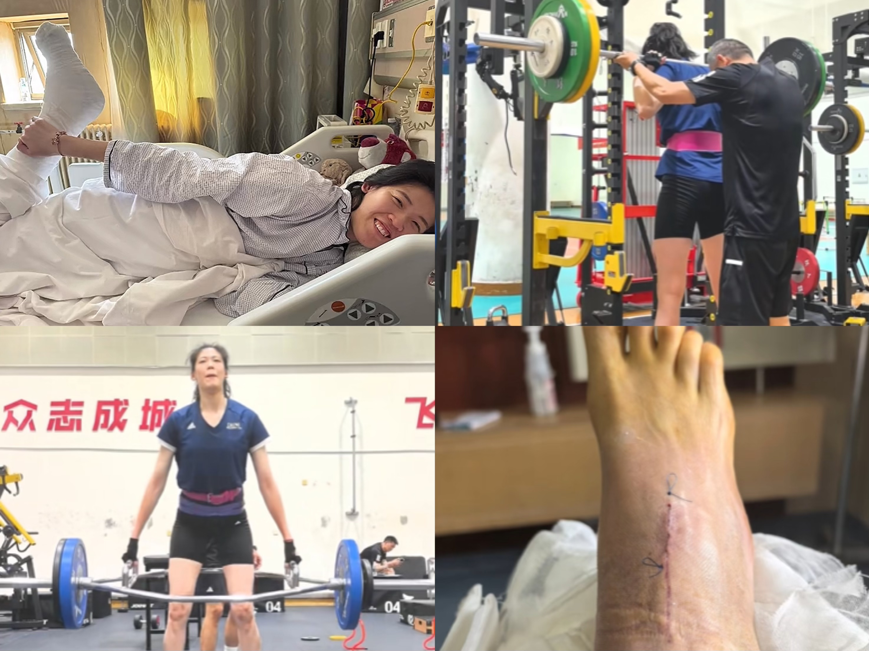 李盈莹公开康复过程 肌肉萎缩 手术留疤 中国女排强力主攻复出