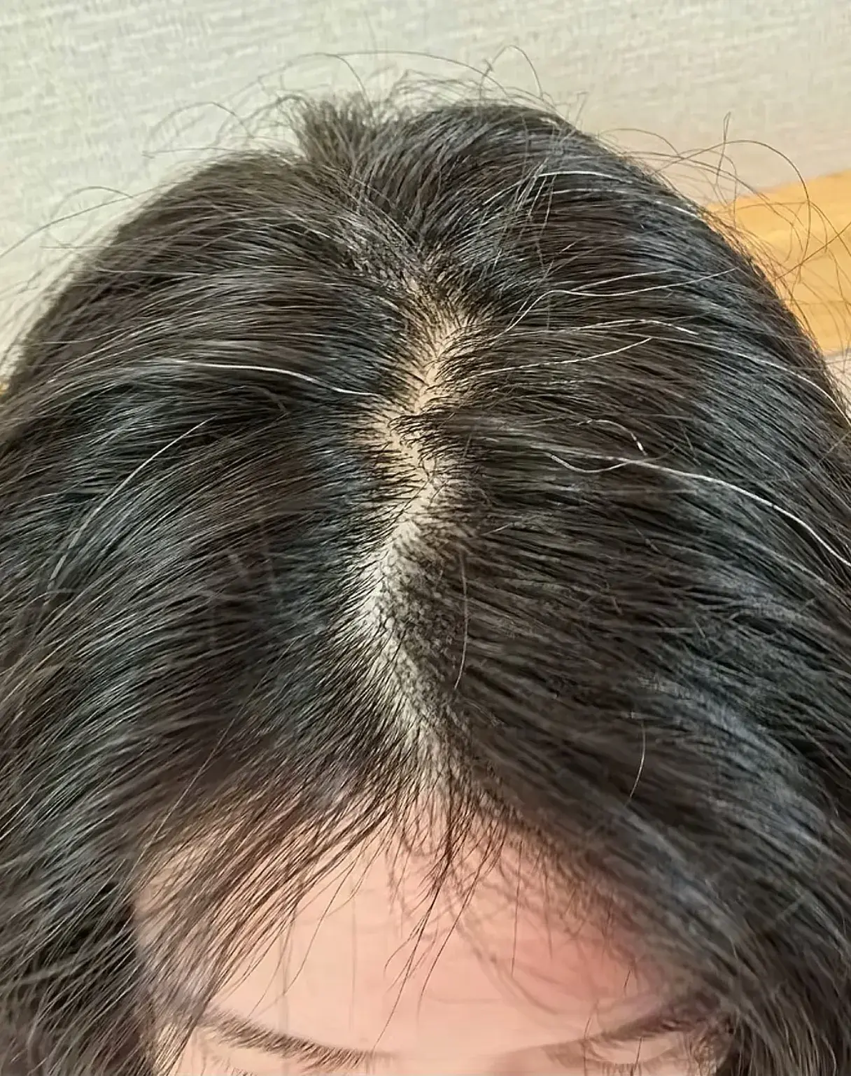 李盈莹发布康复过程！手术照首次公开，白头发抢眼，状态已超预期