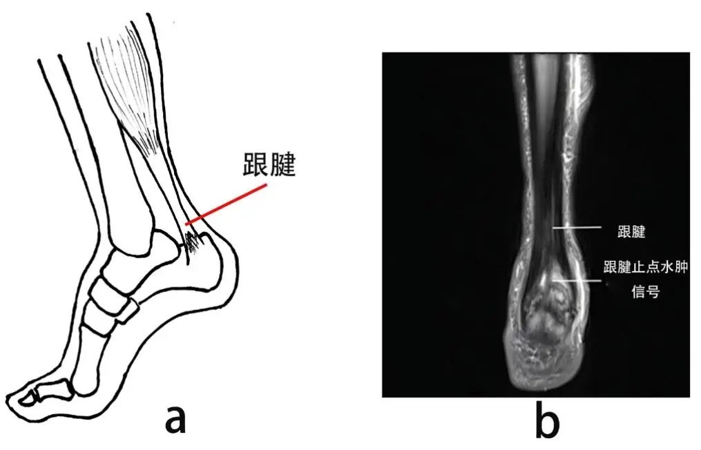 “啪”的一声，男子跨步救球后剧痛倒地！出现这些信号是跟腱在求救→