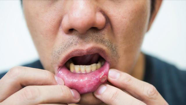 专家发现：吃面喜欢放大量醋的人，一段时间，血管或有几个变化