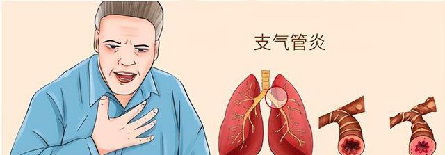 支气管炎出现这6种情况需要及时解决
