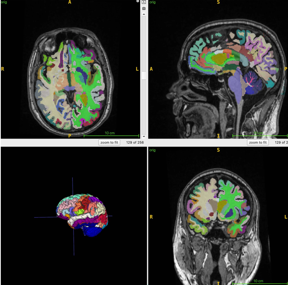 研究显示腹部内脏脂肪会悄悄加速大脑衰老