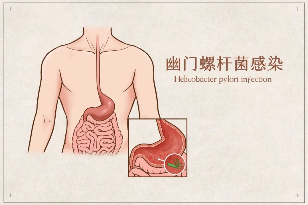 孩子感染幽门螺杆菌，要不要治？