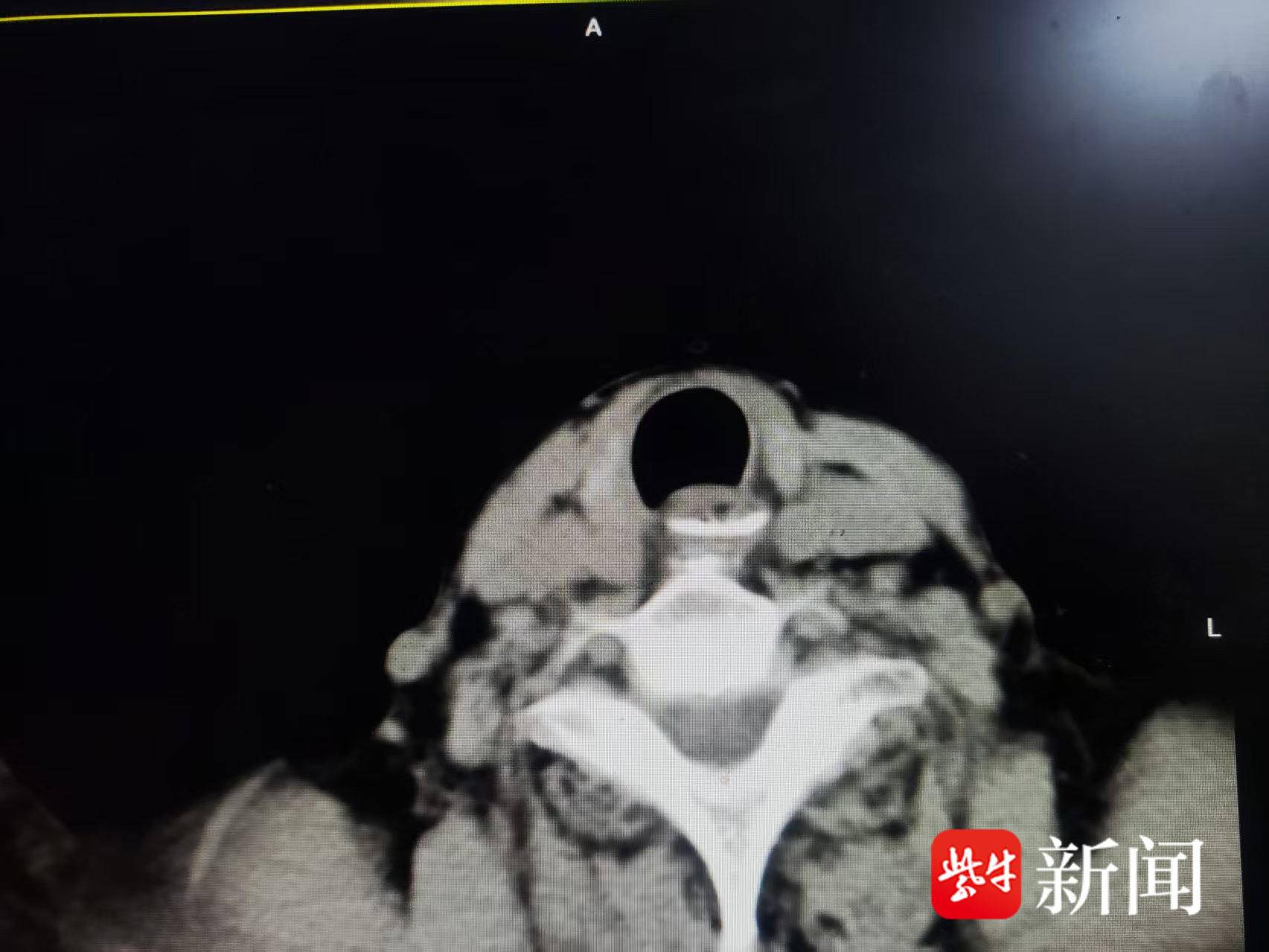 八旬老太误吞鱼刺紧贴心脏大血管，医生提醒：切勿用“土办法”强吞鱼刺