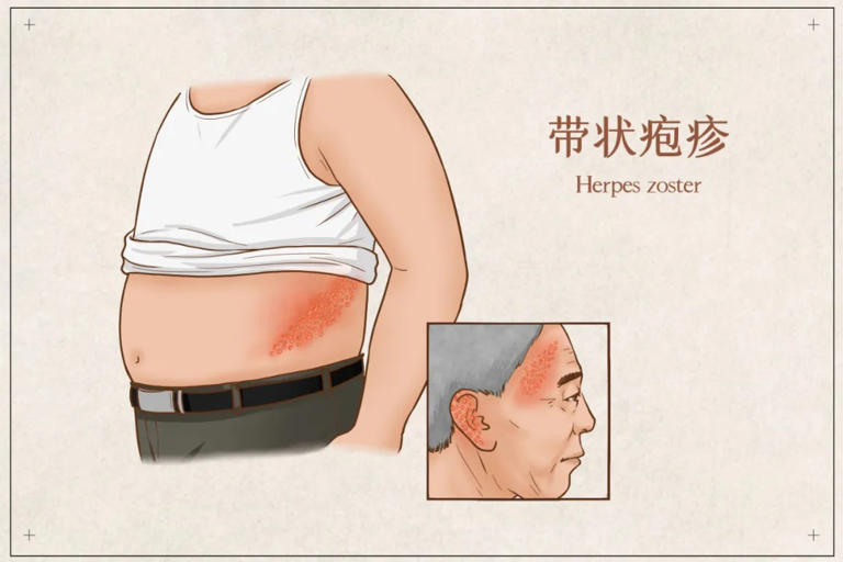 每年冬天杭州都有不少人中招，剧痛难忍，尽早去正规医院!