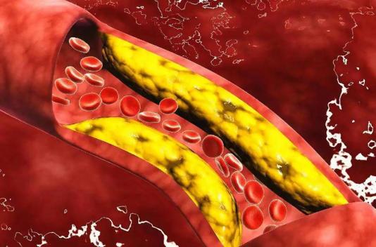 血管“清洁工”被找到！不是木耳，55岁后常吃血管变干净