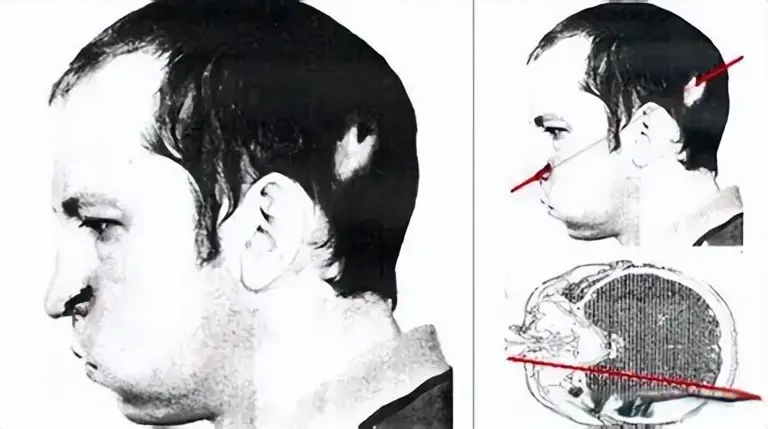 半张脸永不衰老的双面人：粒子加速器运转时，他意外把头伸了进去