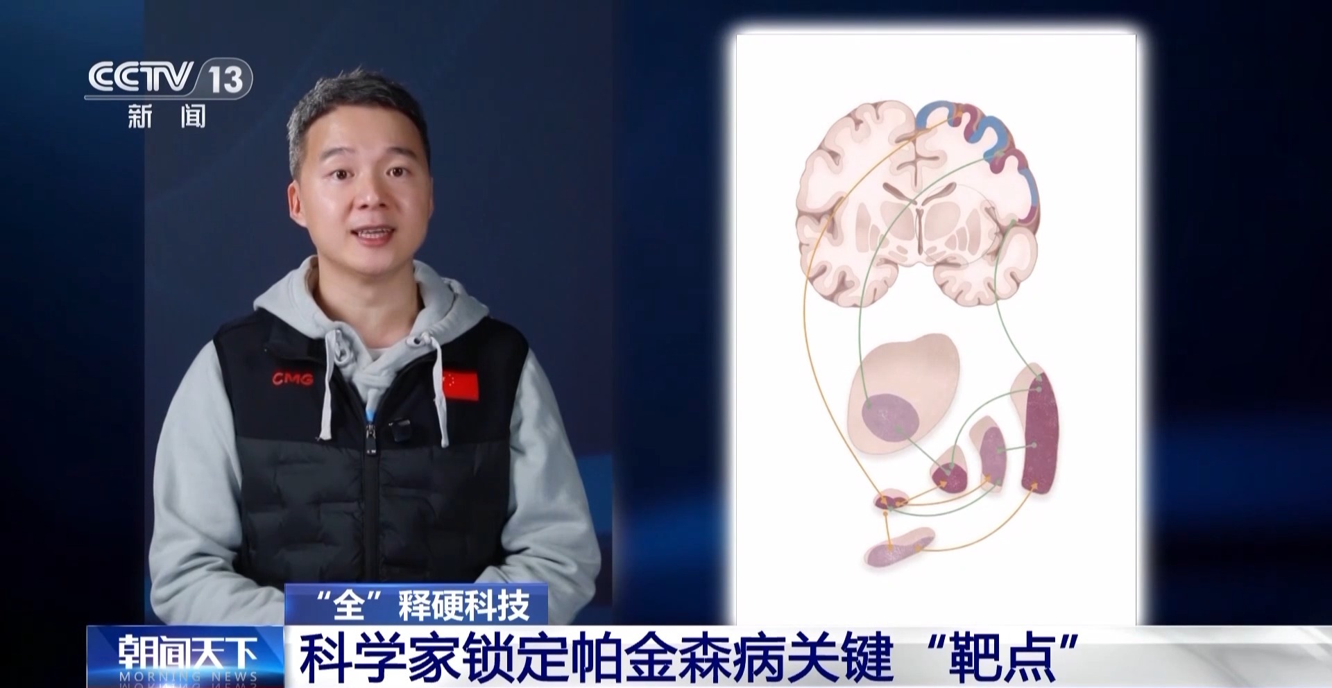 科学家锁定帕金森病关键“靶点” 实现无创精准治疗