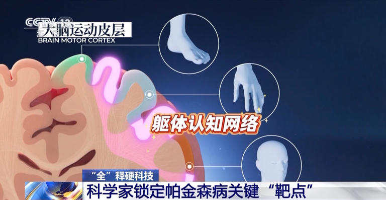 科学家锁定帕金森病关键“靶点” 实现无创精准治疗