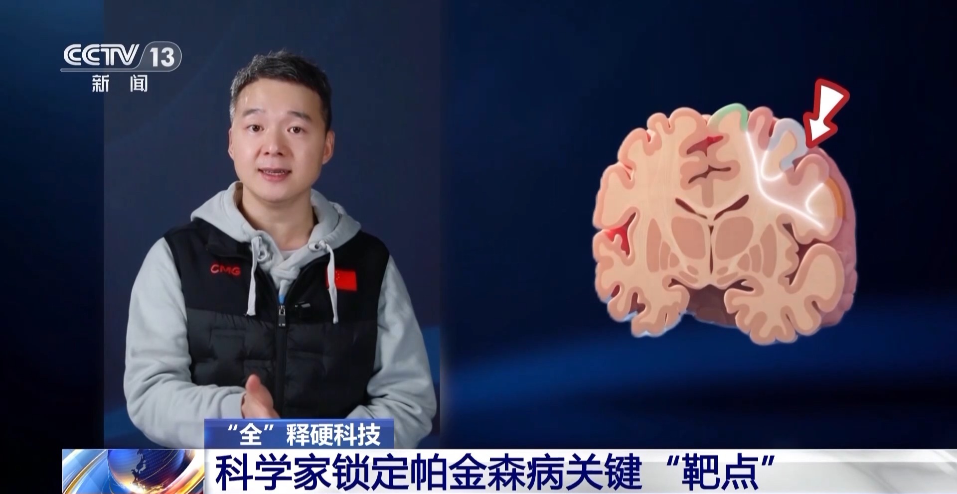 科学家锁定帕金森病关键“靶点” 实现无创精准治疗