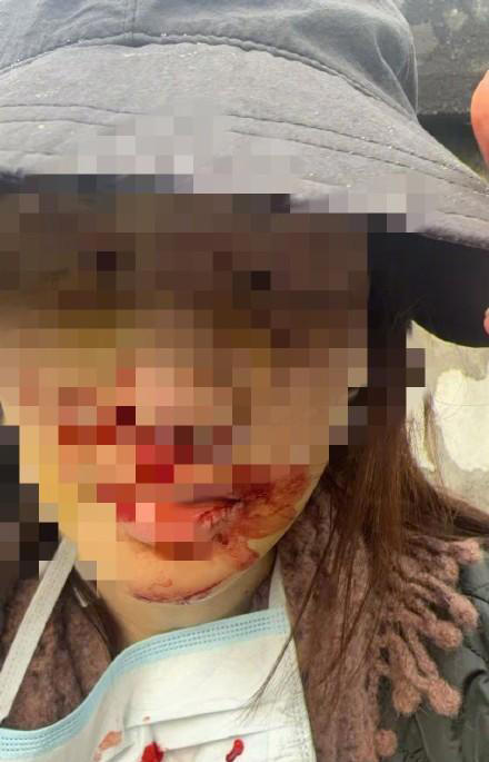 金晨道歉一举三得！晒脸部受伤照有玄机，3大细节对不上惹质疑！