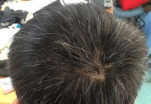 医生发现，凡是白发早生的人，大多都有 2 个共性，日常不妨多观察