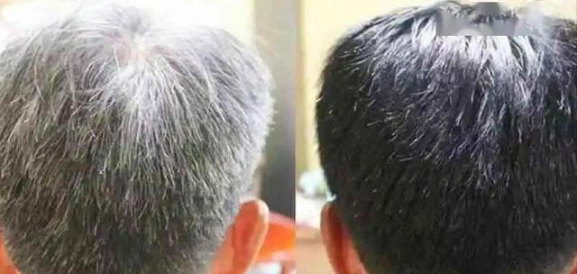 医生发现，凡是白发早生的人，大多都有 2 个共性，日常不妨多观察