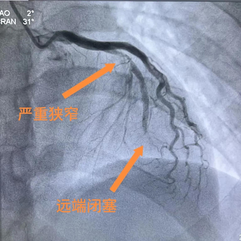 濒死感!浙江33岁小伙梦中因剧痛惊醒，胸口被巨石压住