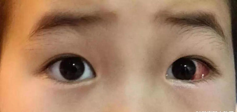 宝宝“斗鸡眼”正常吗?如何判断是否存在“对眼”