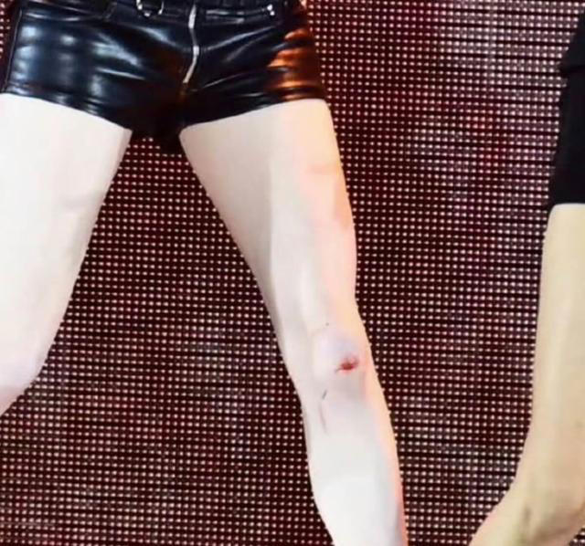 巡演头部受撞击！宋雨琦活动中多次晕眩后紧急就医！父母都来了