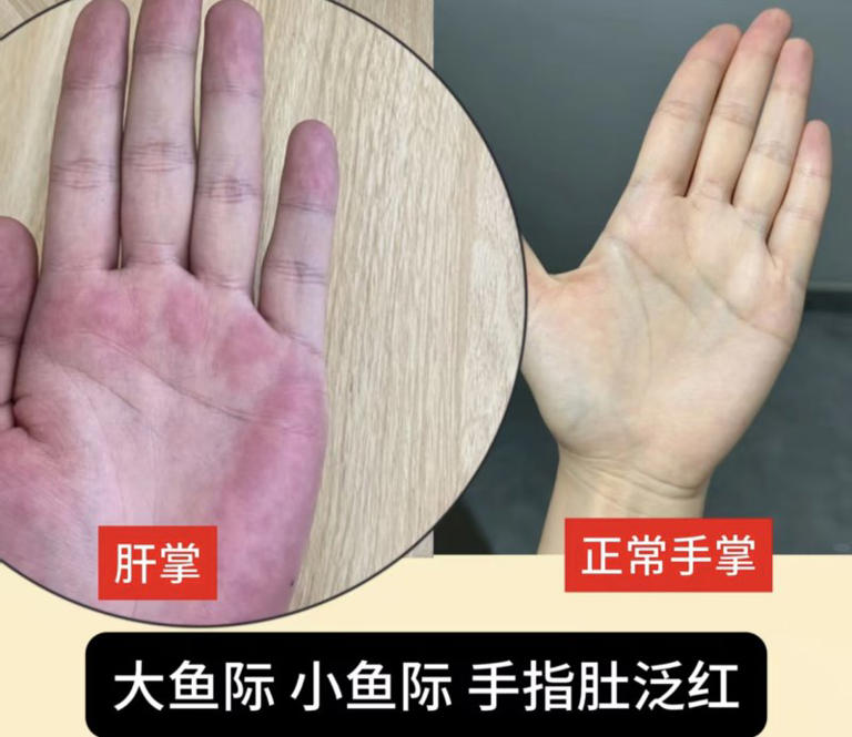 手掌太红疑似“肝掌”?大批网友提醒张雪就医，医生解读