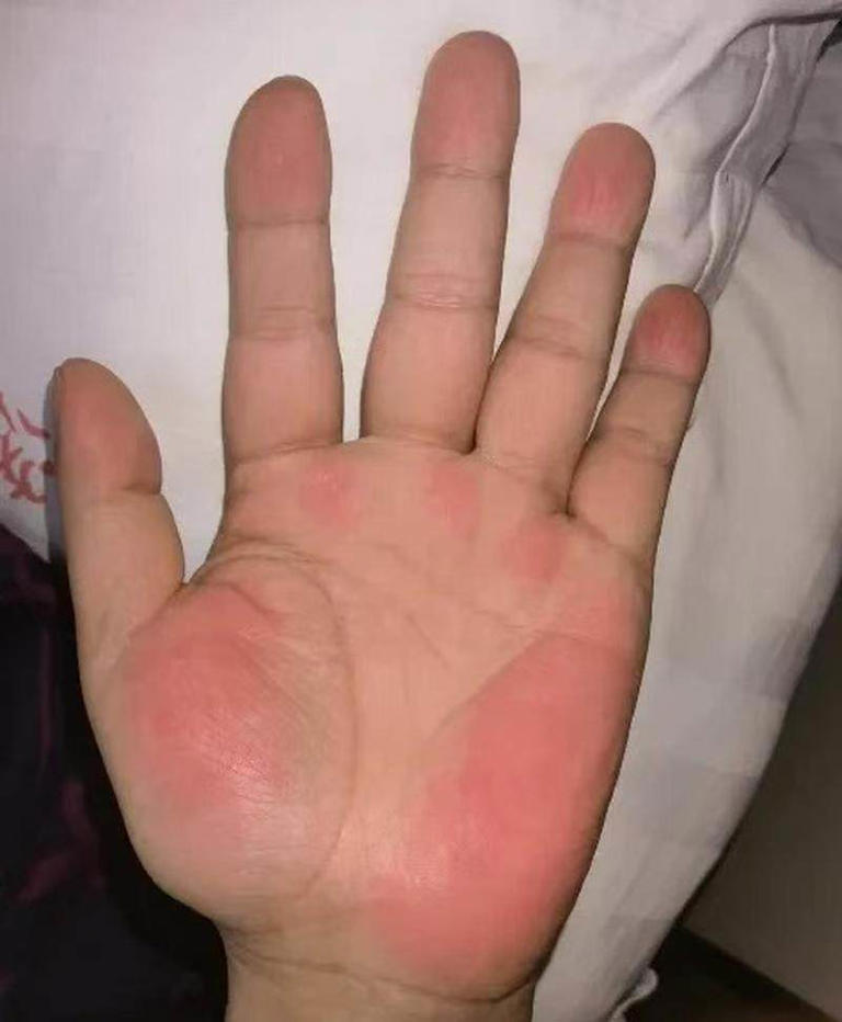 手掌太红疑似“肝掌”?大批网友提醒张雪就医，医生解读
