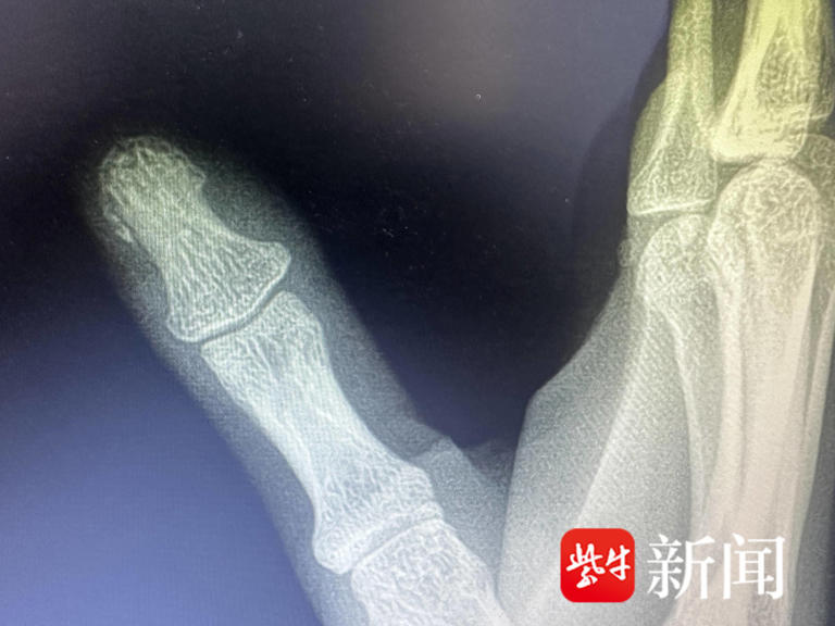 加装的电吸门成“咬手门”!小米SU7车主拇指被夹骨折 官方客服：电吸车门确无防夹功能